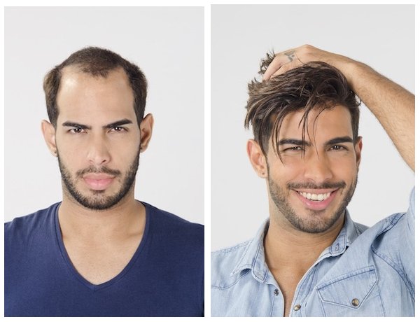 Men's Hair Replacement - Worcester, Massachusetts