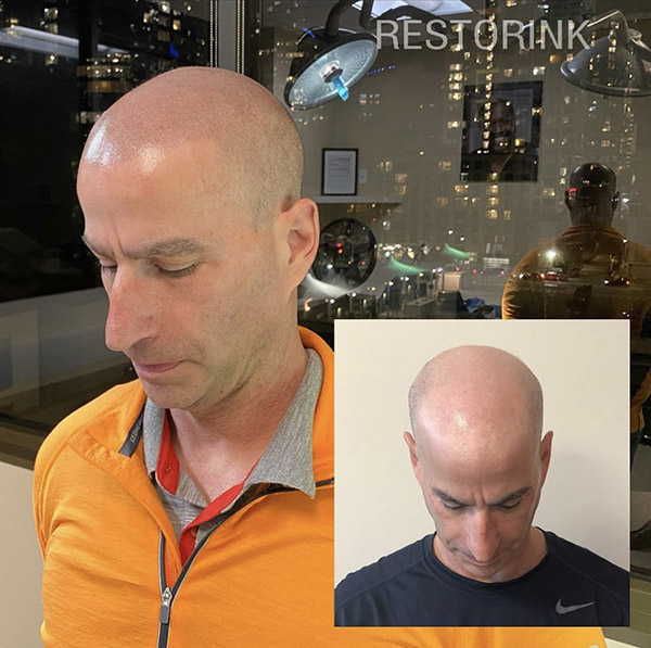 Best clinics for scalp micropigmentation in Lambeth, London