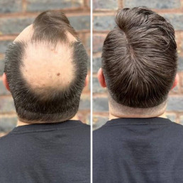 Hair Replacement System